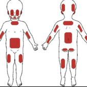 Inflicted Injury in children. Practical approach for Paediatric Radiologists & Paediatricians – online. March 21st 2025